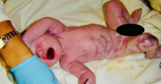 Mom delivers baby, forbidden from holding him when dad utters: “There’s something wrong with Adam’s leg”