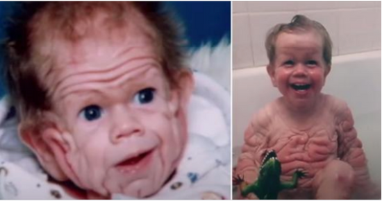 Tomm Tennent: The unique baby born with enough skin to cover the body of a five-year-old child